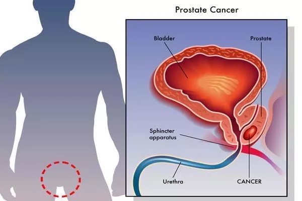 Доклад: Лучевая терапия рака предстательной железы
