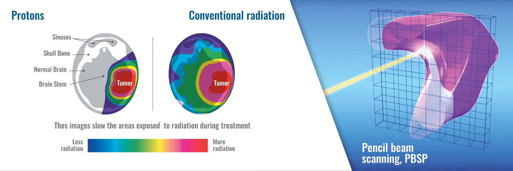 Comparison of radiation dose plans for proton and photon beam therapy