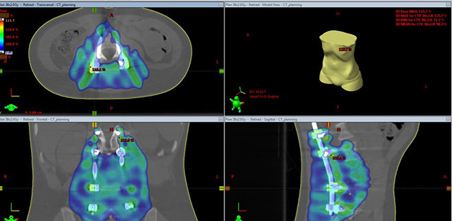 План протонной терапии для пациента с опухолью кости и мателлоконструкцией в позвоночнике